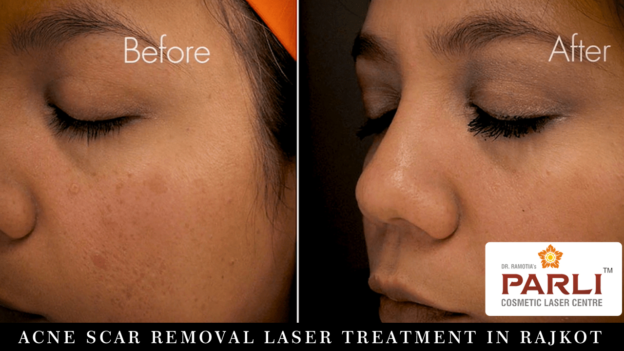 Acne Scar Removal Laser Treatment in Rajkot
