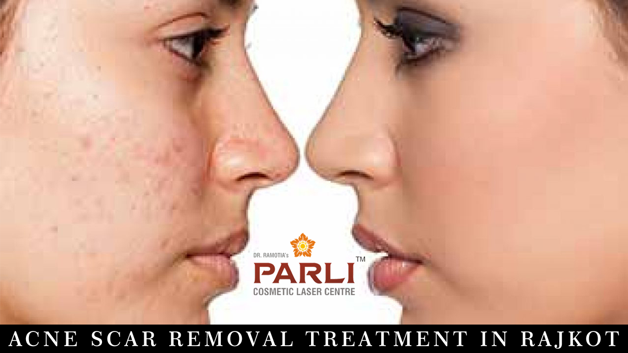 Acne Scar Removal Treatment in Rajkot