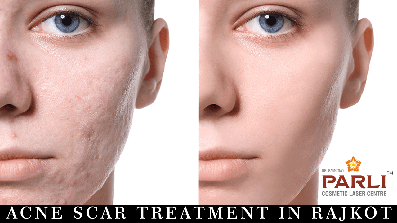 Acne Scar Treatment in Rajkot